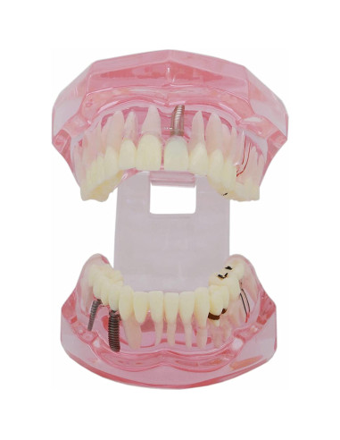 Modelo de Diente Typodont para Implantes Dentales 2001P