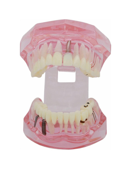 Modelo de Diente Typodont para Implantes Dentales 2001P
