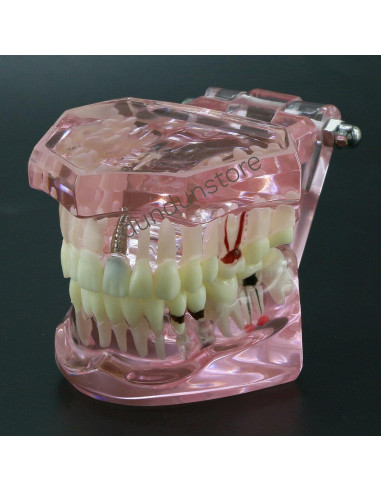 Modelo de Diente Typodont para Implantes Dentales 2001P
