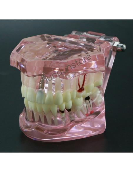 Modelo de Diente Typodont para Implantes Dentales 2001P