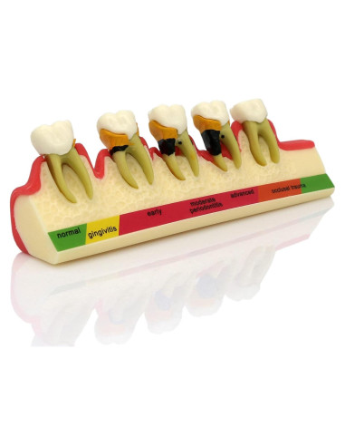 Modelo Typodont Dental M4010 para Enfermedades Periodontales