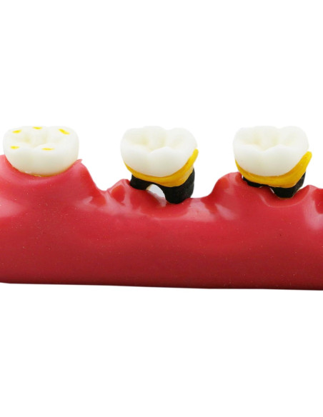 Modelo Typodont Dental M4010 para Enfermedades Periodontales