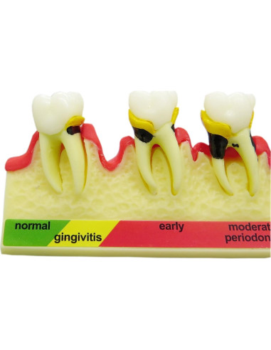Modelo Typodont Dental M4010 para Enfermedades Periodontales
