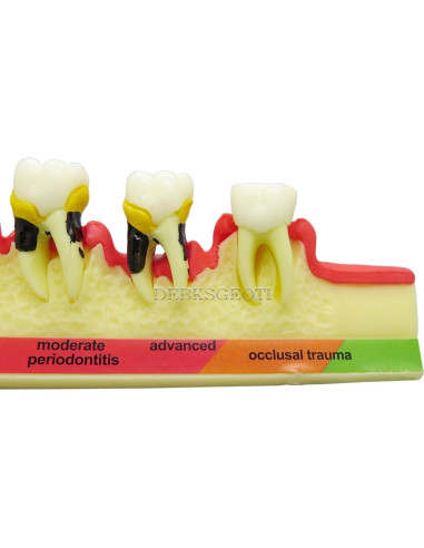 Modelo Typodont Dental M4010 para Enfermedades Periodontales