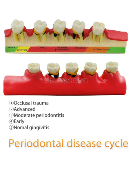 Modelo Typodont Dental M4010 para Enfermedades Periodontales