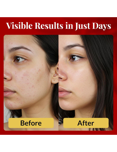 Jabón Face Doctor 95g para Acné y Rosácea - Piel Sensible