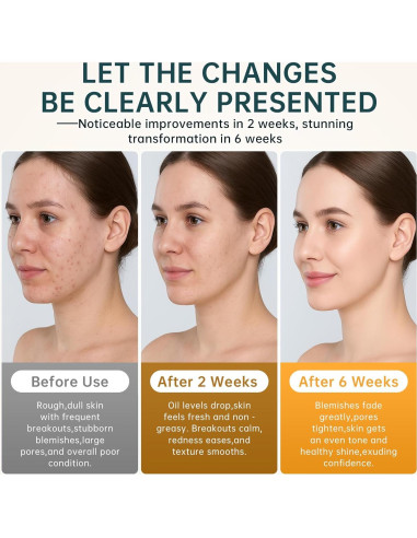 Crema para el Acné BECHOICEN 14% Ácido Azelaico 56.7g