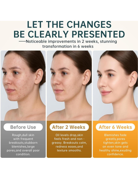 Crema para el Acné BECHOICEN 14% Ácido Azelaico 56.7g