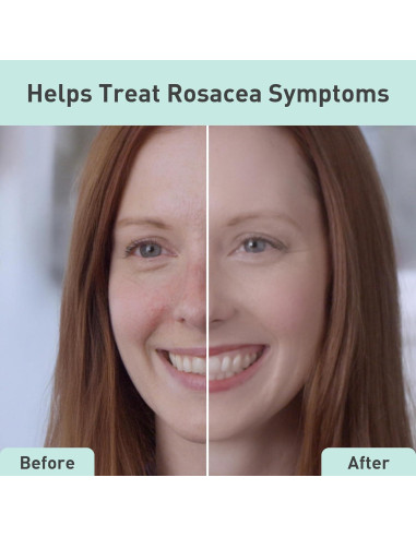 Suero Facial PROcure Rosacare 32ml - Hidratante para Rosácea