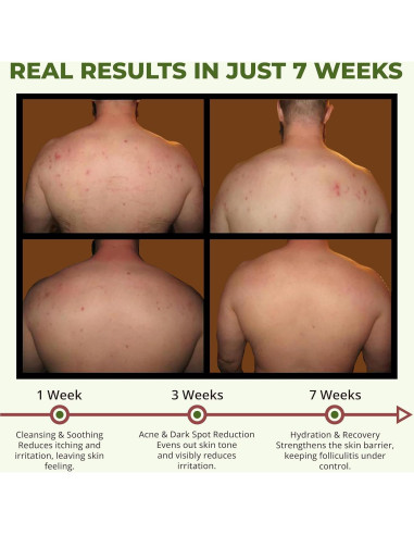 Gel de Ducha ABERA BHA para Foliculitis y Acné Corporal 2 Cajas