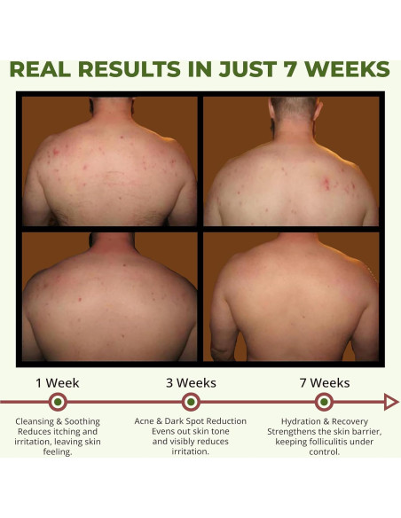 Gel de Ducha ABERA BHA para Foliculitis y Acné Corporal 2 Cajas