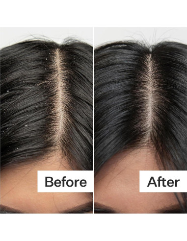 Exfoliante Cuero Cabelludo ACT+Acre 59ml | Ácido Salicílico, Papaya, Menta