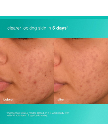 Hidratante Facial Acne Biotic Dermalogica 50 ml - Previene Brotes