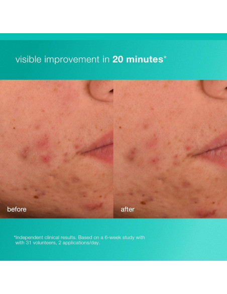 Hidratante Facial Acne Biotic Dermalogica 50 ml - Previene Brotes Hidratante Facial Acne Biotic Dermalogica 50 ml - Previene Brotes