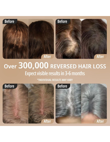 Peine Láser Breo Scalp 3L para Crecimiento del Cabello