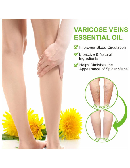 Aceite Esencial IKZEE para Venas Varicosas 30ML - Hidratante