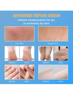 Crema de Urea 60% YOUNGYOUNGLOVE 150ml Hidratante para Pies 2