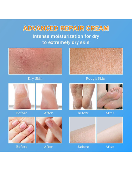 Crema de Urea 60% YOUNGYOUNGLOVE 150ml Hidratante para Pies