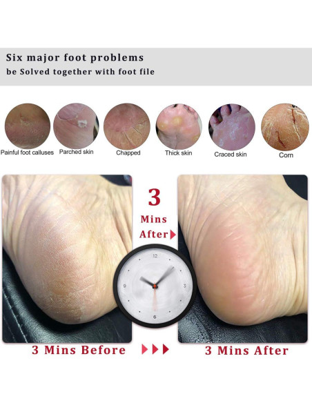 Lima para Pies Kinepi - Removedor de Callos y Durezas 25cm Lima para Pies Kinepi - Removedor de Callos y Durezas 25cm