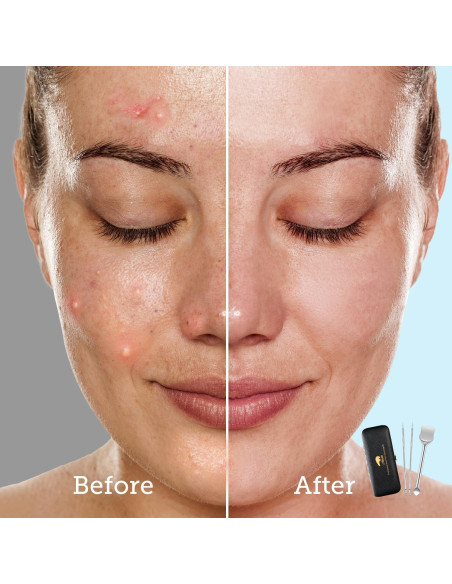 Kit de Herramientas para Remover Puntos Negros LitBear - Acero Inoxidable