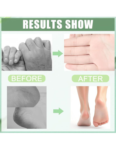 Conjunto Crema Hidratante Urea 60% y Cúrcuma 40g - ASMAYSA