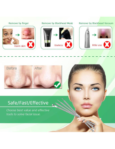 Kit Extractor de Comedones 5 Piezas Kotomotoy Acero Inoxidable