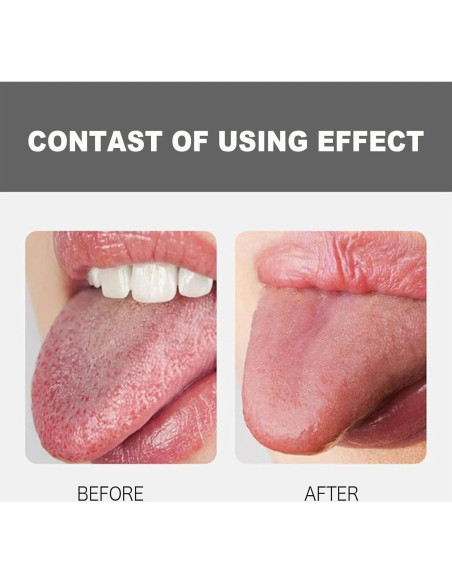 Limpiador de Lengua Acero Inoxidable Qalgtih 2 Piezas