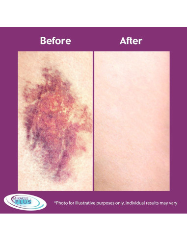 Set de Crema y Gel de Arnica Miracle Plus para Moretones