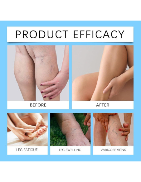 Spray Alivio Venas Varicosas Befada 29.57 ml - Fórmula Natural