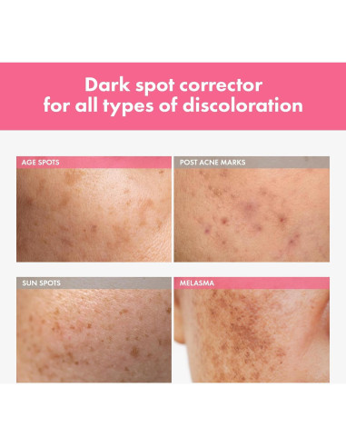 Crema Intensiva para Manchas Tosowoong 20ml - 7% Arbutina