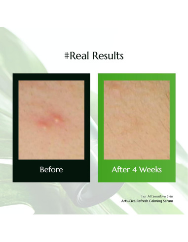 Suero Calmante Refrescante Molvany Arti-Cica 30 ml Piel Sensible