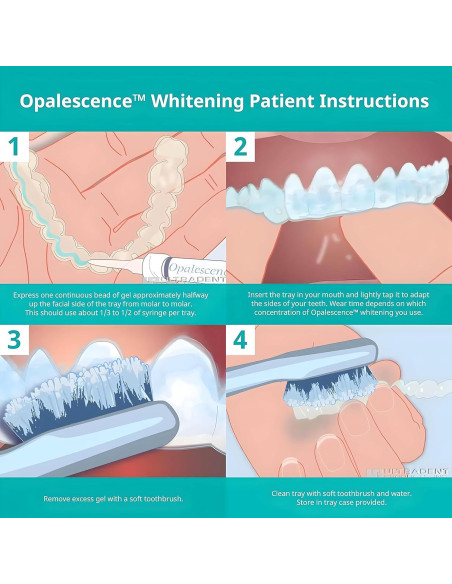 Kit de Blanqueamiento Dental Opalescence 15% - 4 Jeringas
