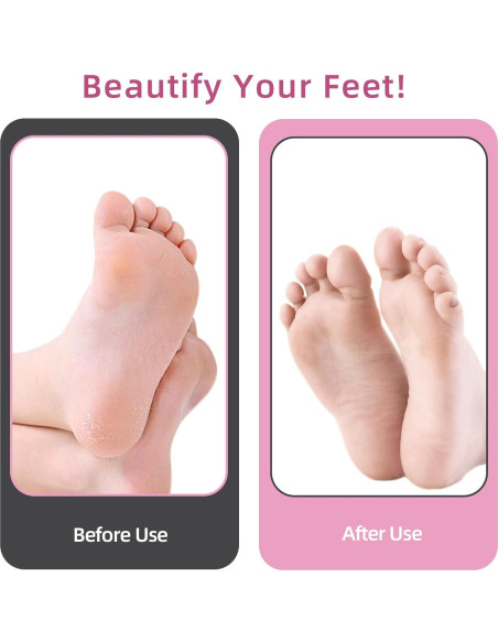 Removedor de Callos Eléctrico APRELM GK-702 Rosa 4.8"