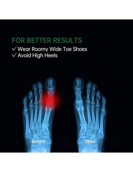 Separadores de Dedos de Gel TEXSENDA 12-Pack para Juanetes