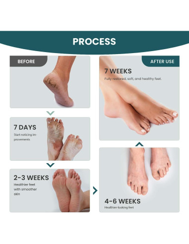 Kit de Cuidado de Pies Aifufand 3 Piezas - Spray Jengibre, Removedor Callos, Crema Hidratante