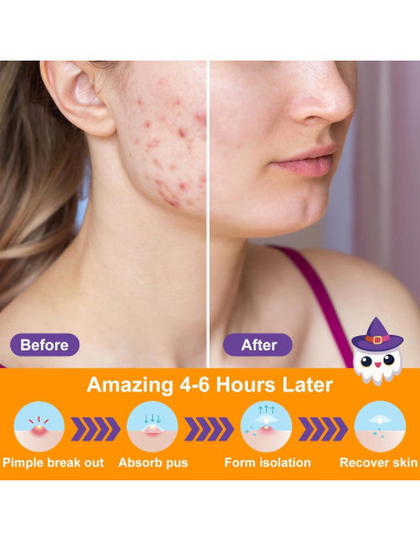 200 Parches para Acné Halloween Ouvibor con Ácido Salicílico