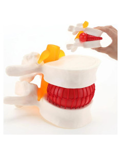 Modelo de Herniación del Disco Lumbar LYOU - 10x10 cm