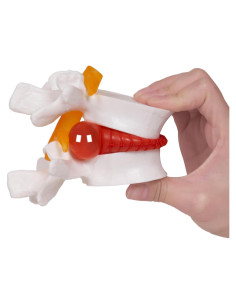 Modelo de Hernia de Disco Lumbar Breesky 1.5x Detalle