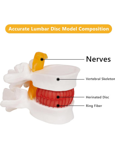 Modelo de Hernia de Disco Lumbar Breesky 1.5x Detalle