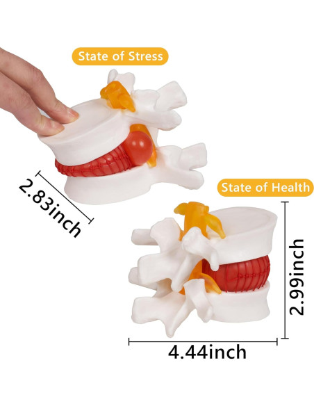 Modelo de Hernia de Disco Lumbar Breesky 1.5x Detalle