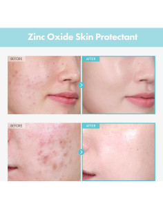 Crema de Zinc CICA SOS Repair MANTONG 50g - Alivia Acné y Enrojecimiento 2