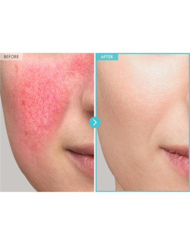 Crema de Zinc CICA SOS Repair MANTONG 50g - Alivia Acné y Enrojecimiento