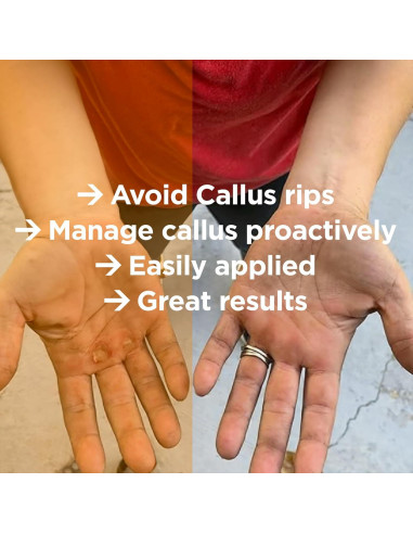 Callus Score - Removedor de Callos para Atletas 12.7cm