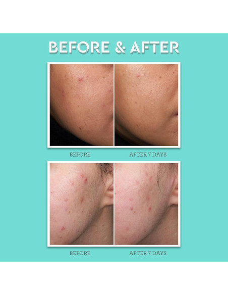 Tratamiento de Manchas de Acné Bliss Clear Genius 2% Ácido Salicílico 14.79 ml