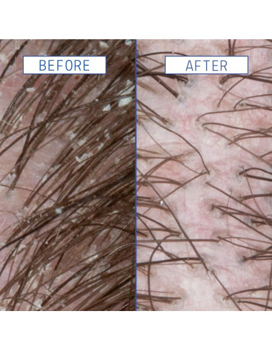 Suero AAVRANI para Cuero Cabelludo - 59.15 ml - Ácido Salicílico