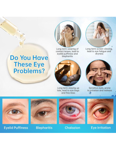 Suero para Ojos MIZEEYE 2 PCS - Tratamiento Chalazión y Blefaritis