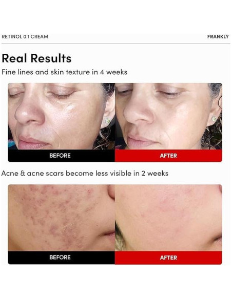 Crema de Retinol 0.1% Frankly 30 ml - Antienvejecimiento y Hidratación