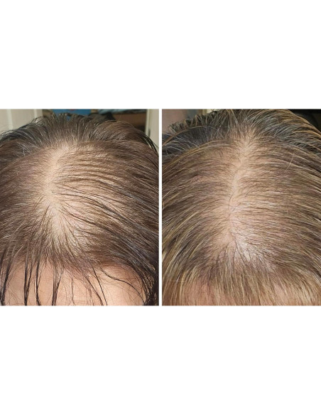 Set Aceite para Cuero Cabelludo y Cepillo Finalmente 368g Set Aceite para Cuero Cabelludo y Cepillo Finalmente 368g