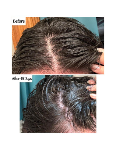 Set Aceite para Cuero Cabelludo y Cepillo Finalmente 368g