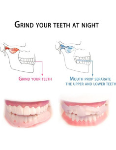 Protector Dental BKID Anti Bruxismo - Guardias de Dientes 2